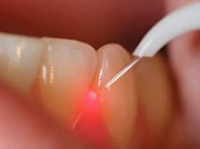 Laserterapia na odontologia